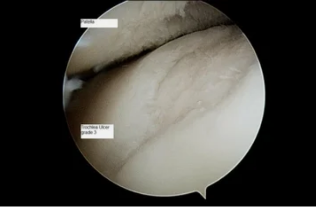 tipo de astroscope en la articulación de la rodilla con artrosis de 3er grado