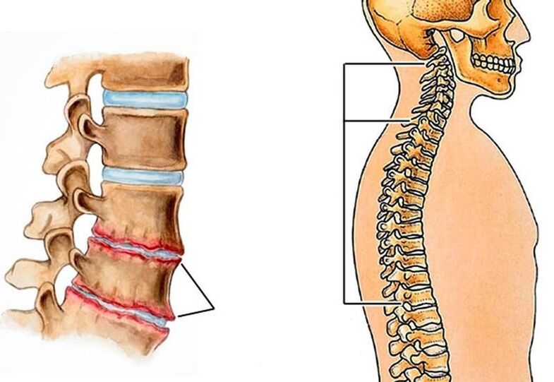 La curvatura de la columna provoca dolor de espalda. 