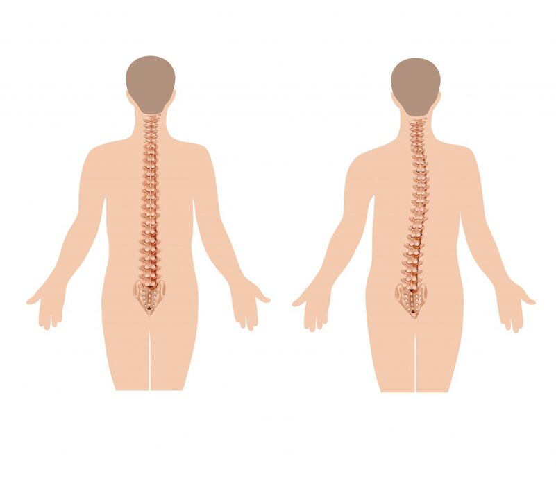 columna vertebral sana y enferma