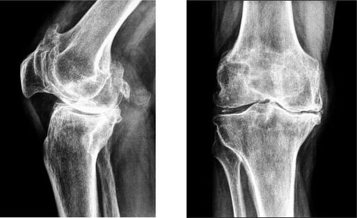 Radiografía de gonartrosis de la rodilla. 