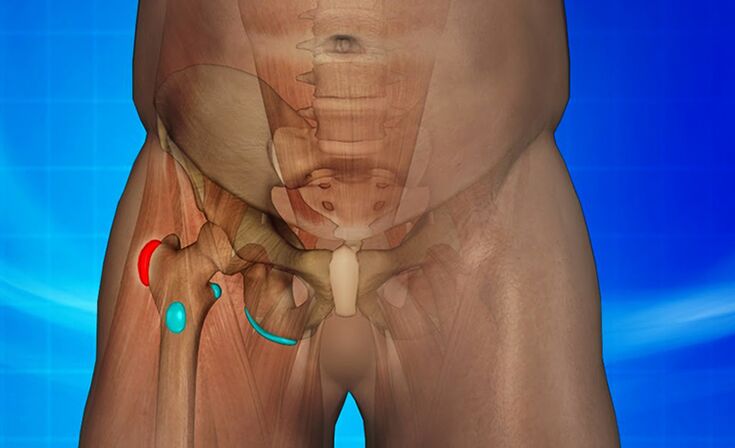 Inflamación de la articulación de la cadera como causa del dolor. 