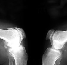 La osteoartritis en x-ray