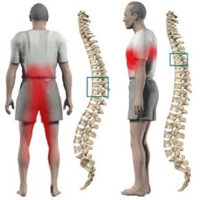 Protuberancia en la columna