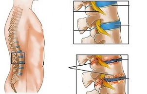 Causas de la osteocondrosis de la columna lumbar. 