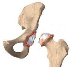 Causas de la osteoartritis de la articulación de la cadera. 