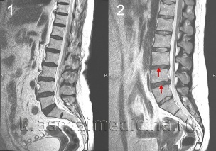 osteocondrosis de la columna vertebral