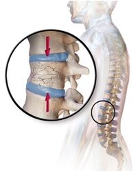 La osteoporosis causa dolor de espalda en la zona lumbar