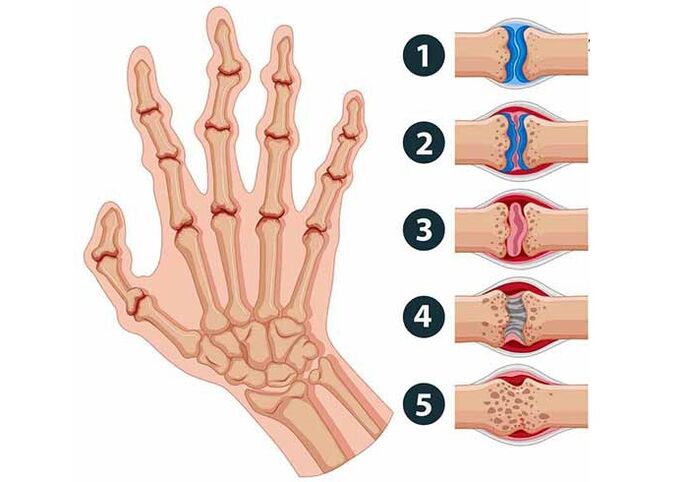 Etapas de desarrollo de la artritis de las articulaciones de los dedos. 